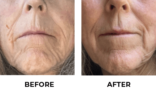 before and after CO2 laser skin resurfacing