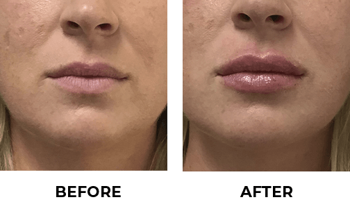 before and after hyaluronic acid filler, actual synergy patient no touch ups