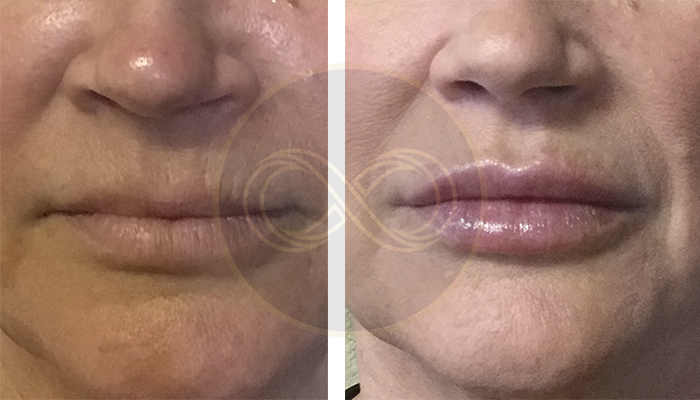 Before after lip filler