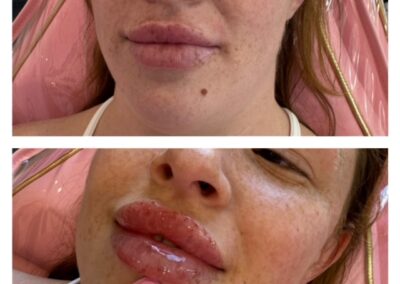 Before and After Lip Filler