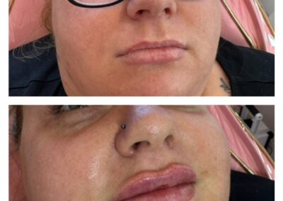 Before and After Lip Filler