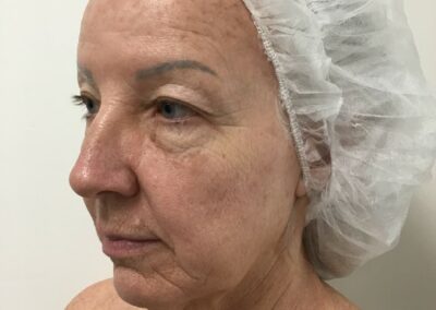 Before CO2 Laser Resurfacing