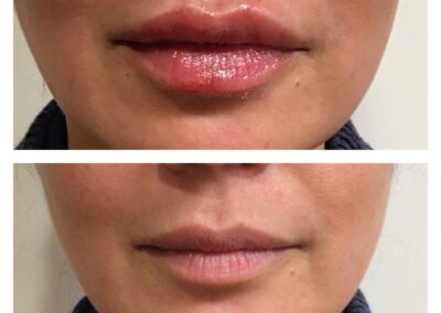 Before and After Lip Filler injection