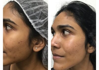 Before and After one chemical peel and 2 Micro needling with exosomes