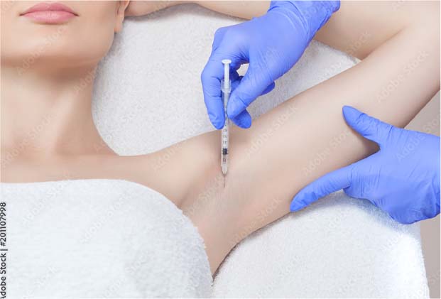 How Does BOTOX® Treat Hyperhidrosis? How Does BOTOX® Treat Hyperhidrosis?