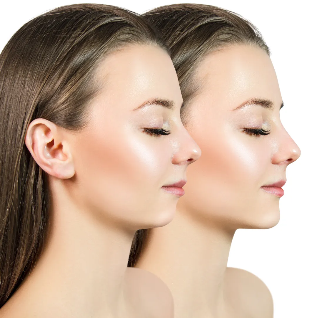 Cheek Filler Options Cheek Filler Options