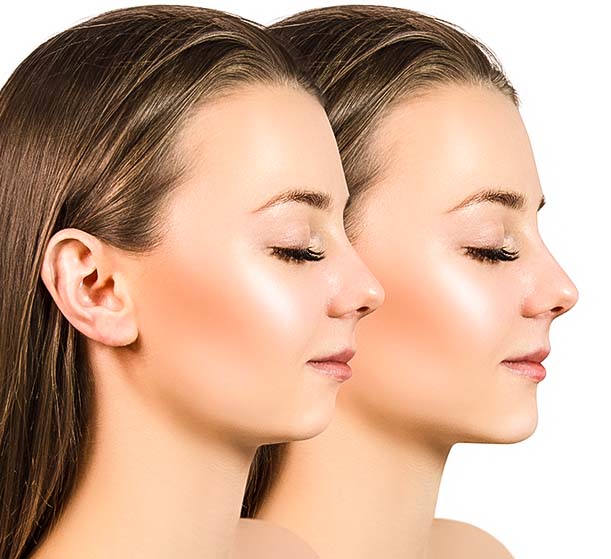What is chin filler What is chin filler